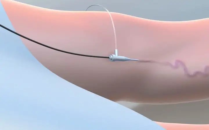 Illustration of an arm undergoing vein treatment with a cylindrical diffuser