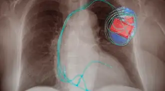 X-ray image showing pacemaker with titanium housing