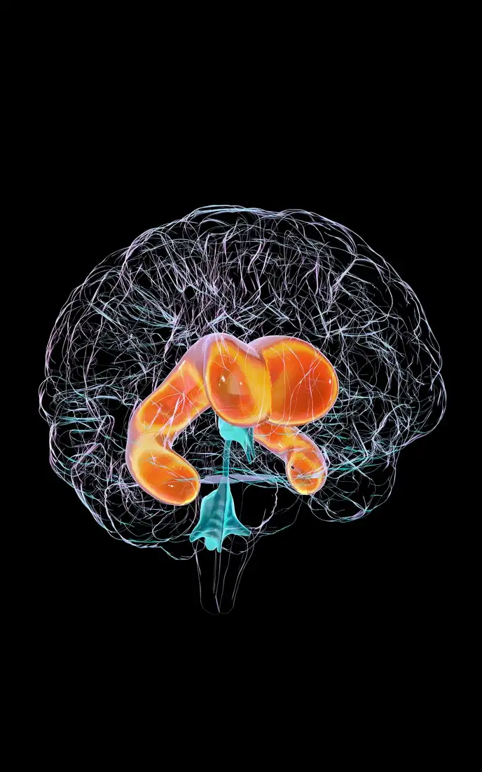 3D-Illustration eines menschlichen Gehirns mit Hydrocephalus