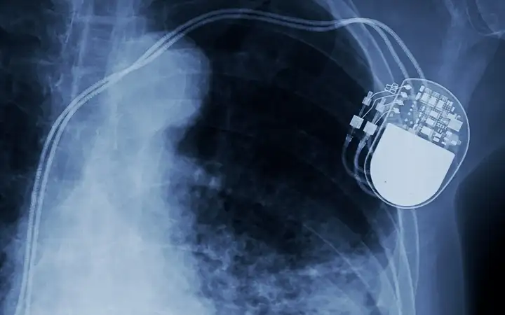 X-ray image of an active medical implant